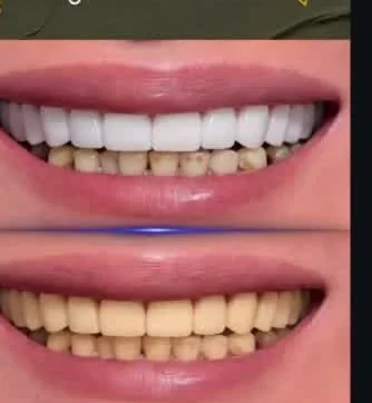 قبل وبعد — ابتسامة