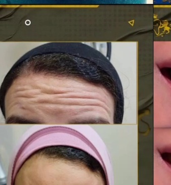 حالة قبل وبعد من محتوى مركز السحر
