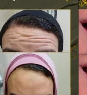 نتائج تجميل الوجه